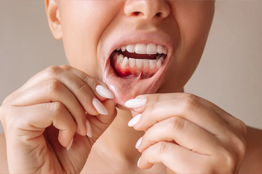 Gum Diseases: Symptoms, Treatment, and Prevention Methods